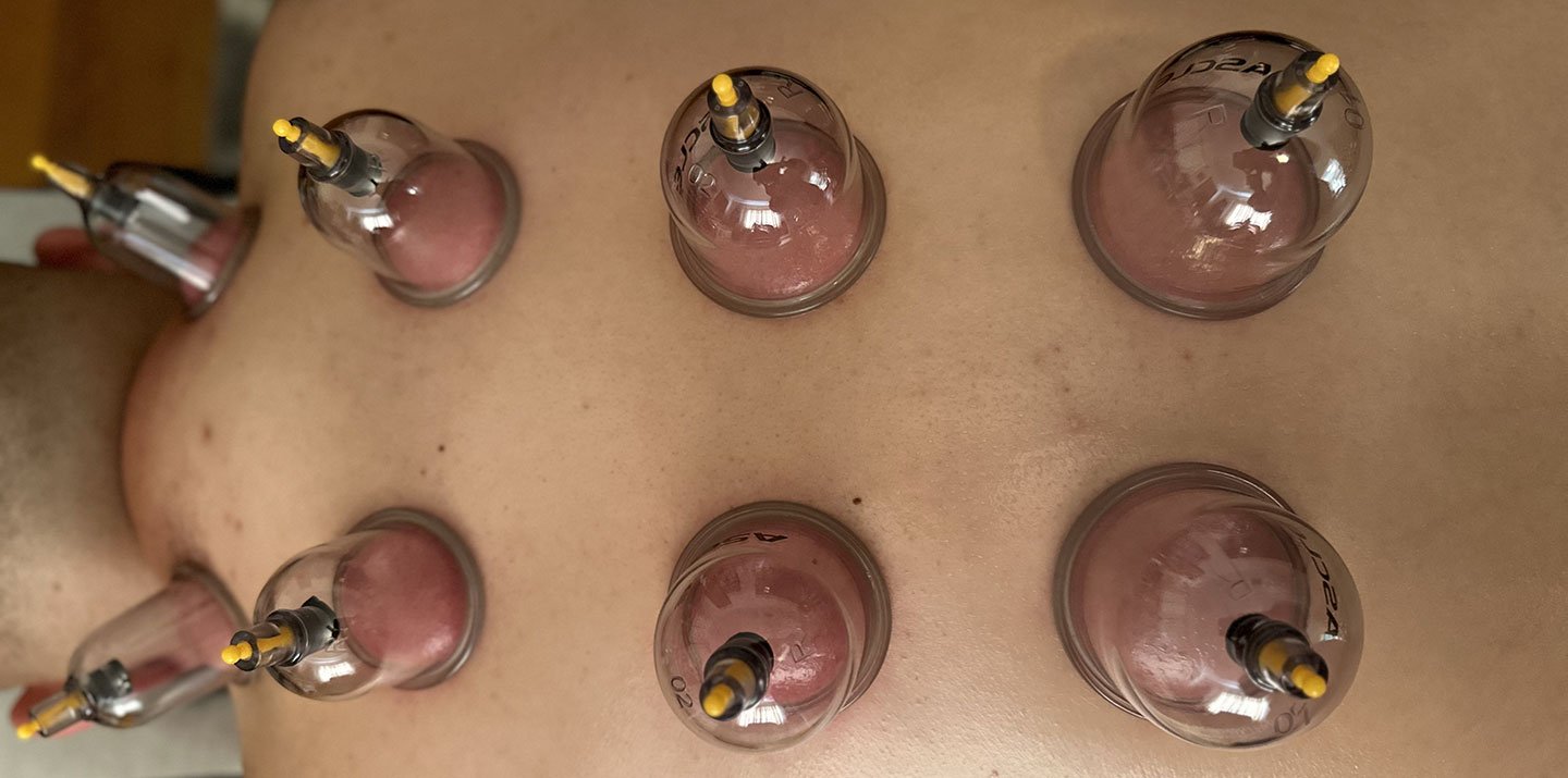 Patient undergoing the cupping services provided by Dr. Chitra Rajendran.