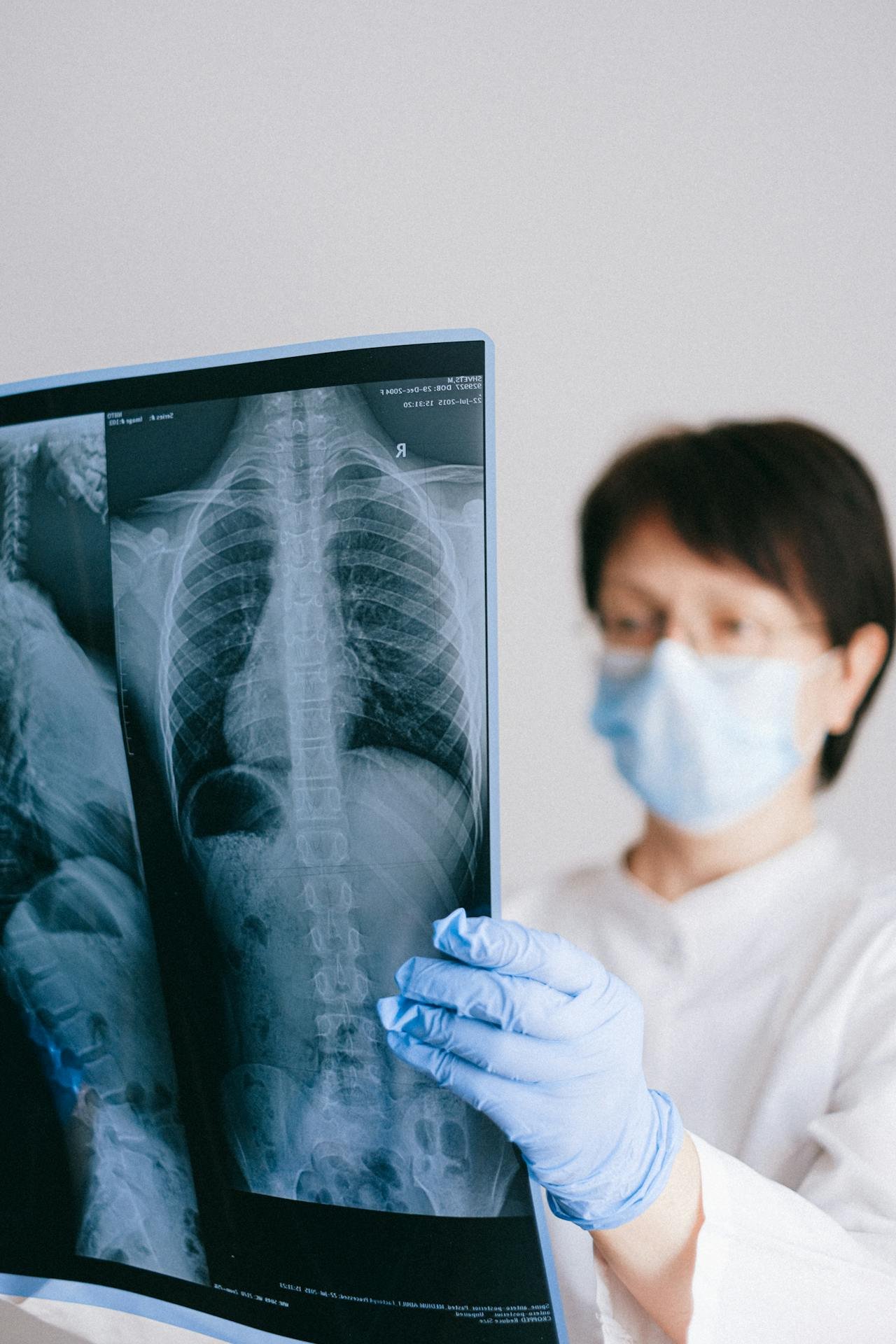 Doctor reviewing spine x-ray for scoliosis diagnosis